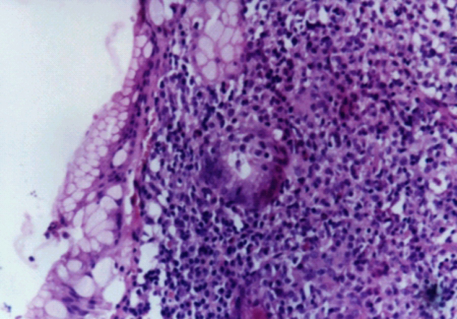 Fig.2: Lesión linfoepitelial. - <div style=